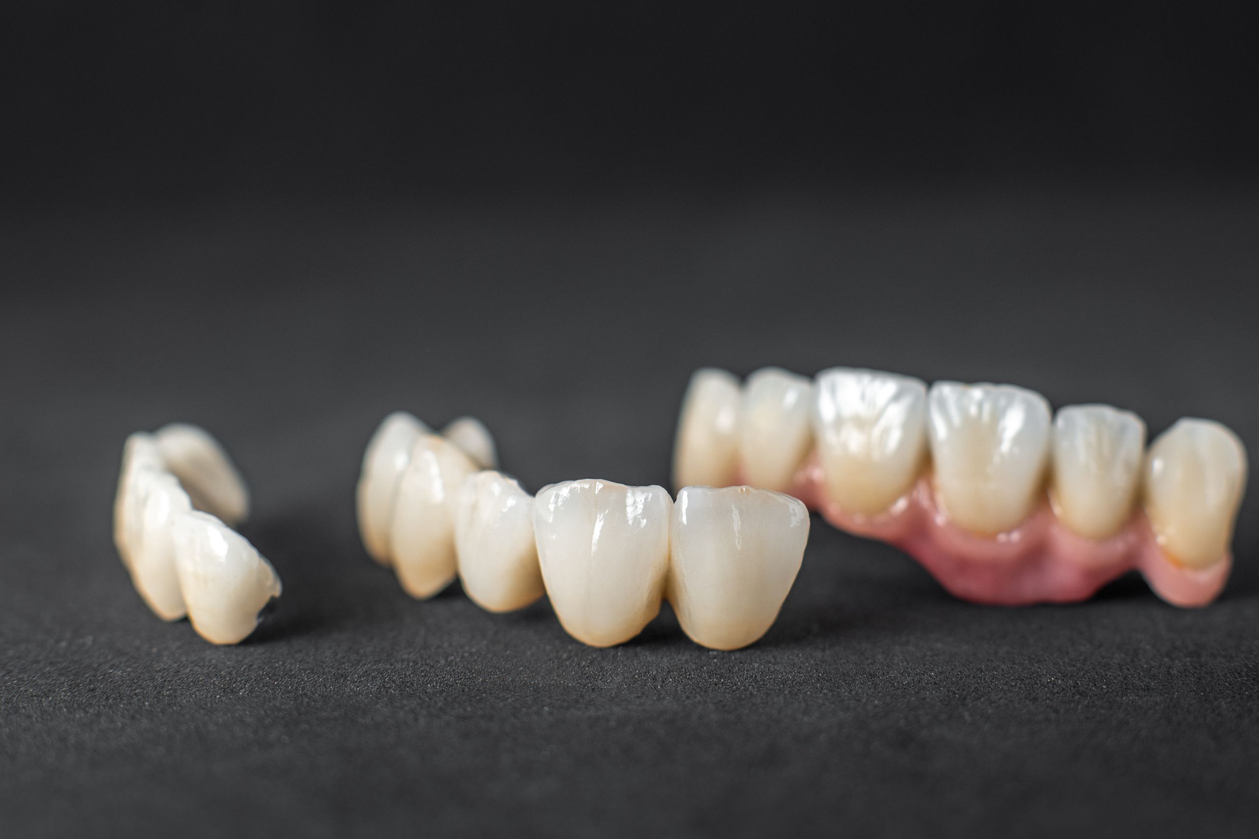 Image showing the previous discolored crowns getting replaced by new set of dental crowns
