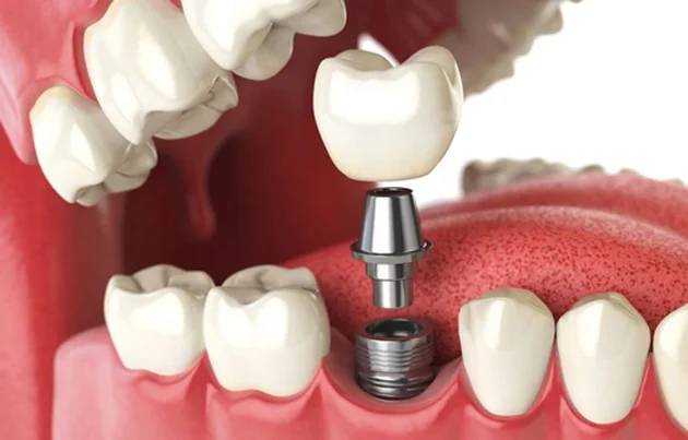 3D Illustration of Single Tooth Implant at Oklahoma Implant and Sedation Dentistry 