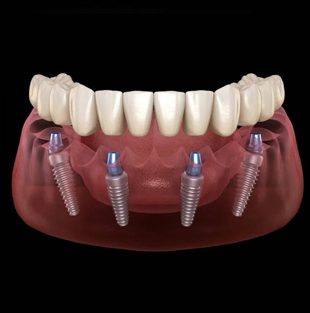3D Illustration of a Dental Implants in Oklahoma City 