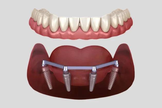 3d image working model of All on 4 Dental Implants at Oklahoma Implant and Sedation Dentistry