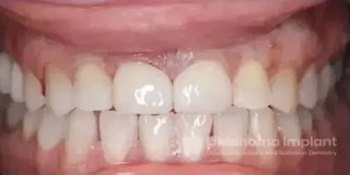 After Implant Placement at Oklahoma Implant and Sedation Dentistry 