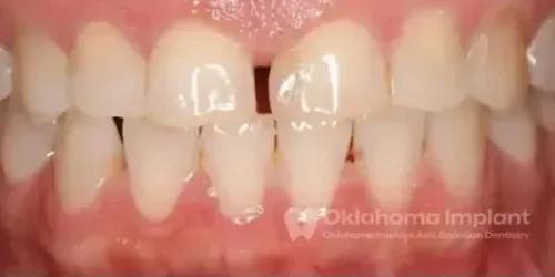 Before Implant Picture at Oklahoma Implant and Sedation Dentistry 