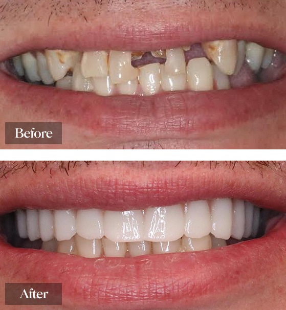 Before and After having Dental Implant at Warwick Dental