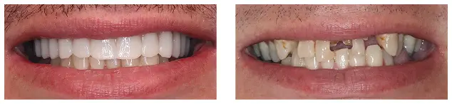 Before and After images of dental implant procedure in Oklahoma City, OK
