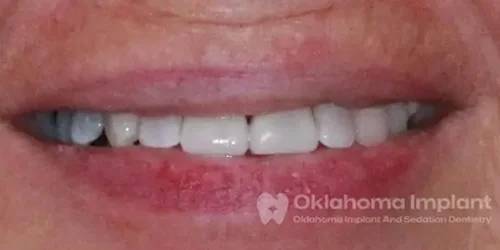 Corrected teeth after the dental implant procedure at Oklahoma Implant and Sedation Dentistry