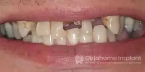 Damaged teeth before implant procedure at Oklahoma City