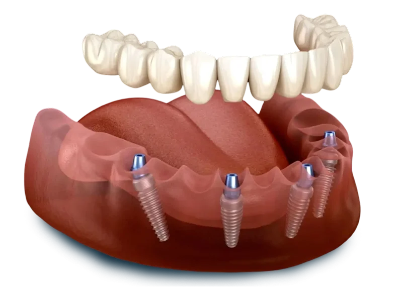 Image of All On 4 Dental Implants structure in Oklahoma City, OK 