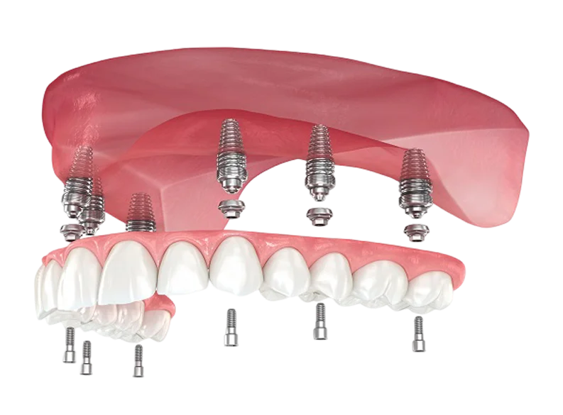 Image of Implant Denture structure in Oklahoma City, OK