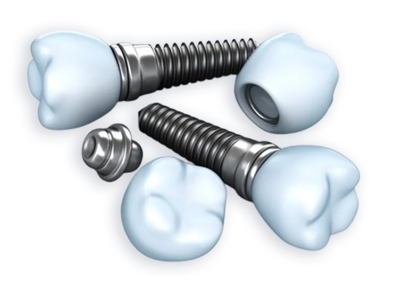Image of dental implants structure at Oklahoma Implant and Sedation Dentistry