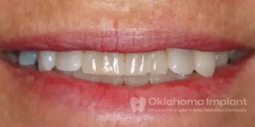 Ripped teeth before dental Implant in Oklahoma City