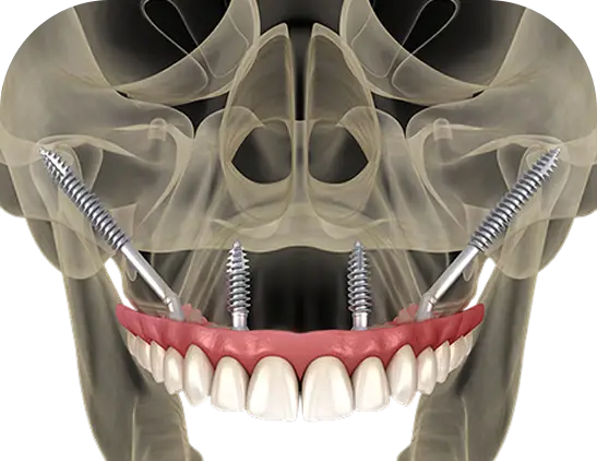 Zygomatic Implants Method 3D image at Oklahoma Implant and Sedation Dentistry 