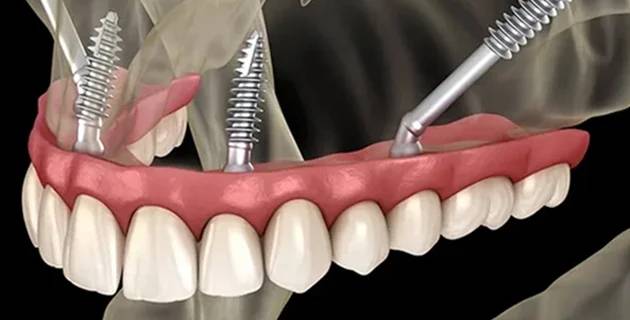 3d image of Zygomatic Implants procedure in Oklahoma City
