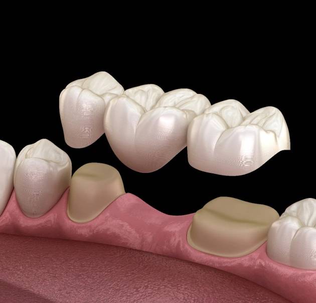 Illustration showing the process of placing dental crowns and bridges in the mouth at Warwick Dental