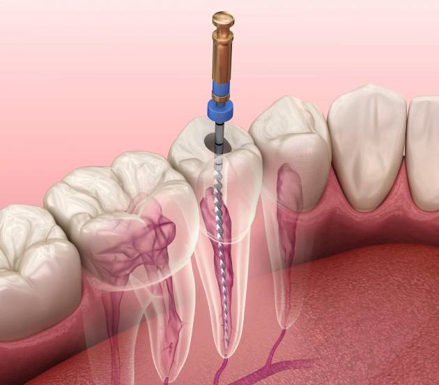 Illustration of the procedure of periodontal disease treatment with deep cleaning of infected tooth and surrounding tissue at Warwick Dental