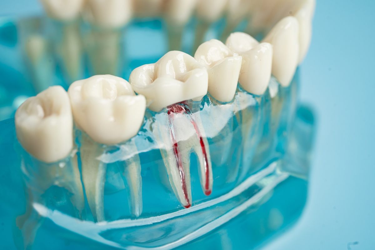 root canal therapy in Oklahoma City